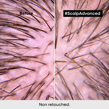 Scalp Advanced Anti-Discomfort Lipid Shield - Serie Expert | L'Oréal Partner Shop
