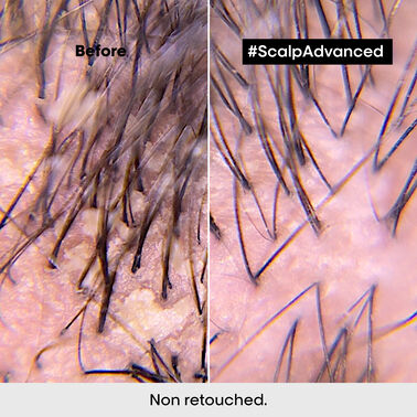 Scalp Advanced Anti-Dandruff Shampoo - Serie Expert | L'Oréal Partner Shop